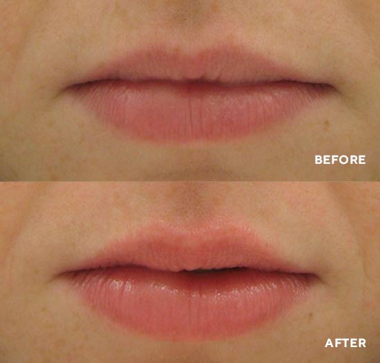 Hydropeptide PERFECTING GLOSS ягодный, УВЕЛИЧИВАЮЩИЙ ОБЪЕМ И УВЛАЖНЯЮЩИЙ КРЕМ ДЛЯ ГУБ, 4 мл 3